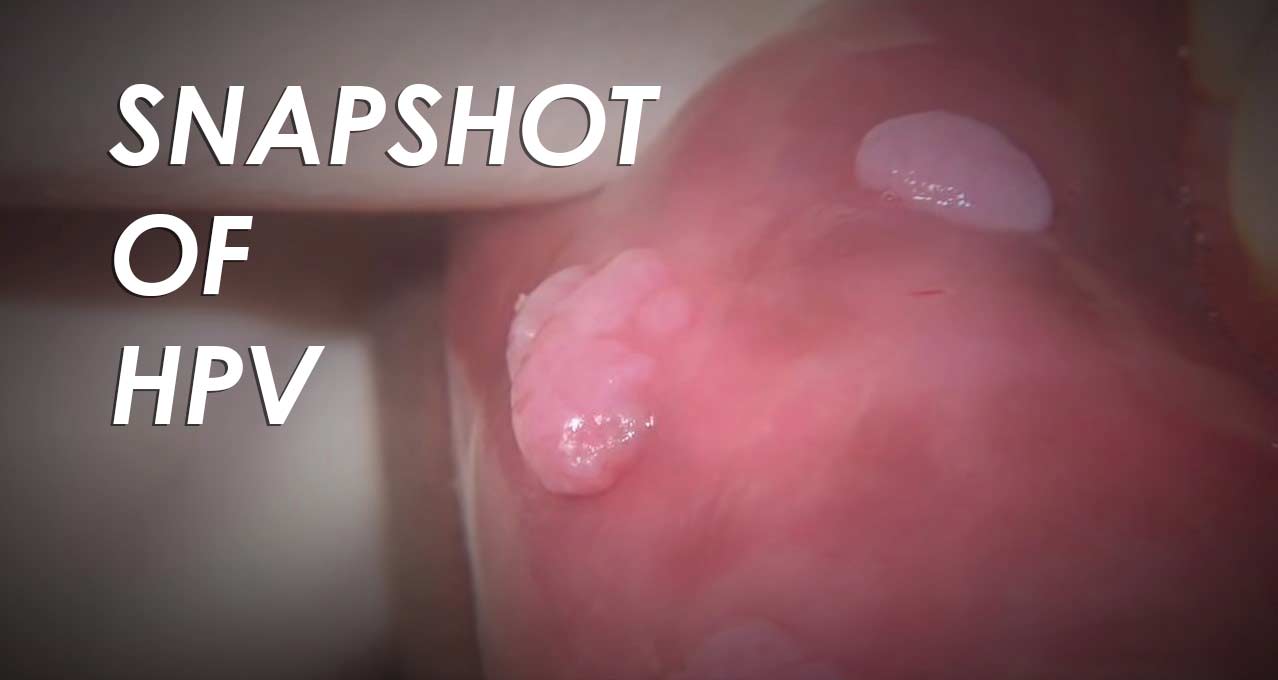 Snapshot of HPV