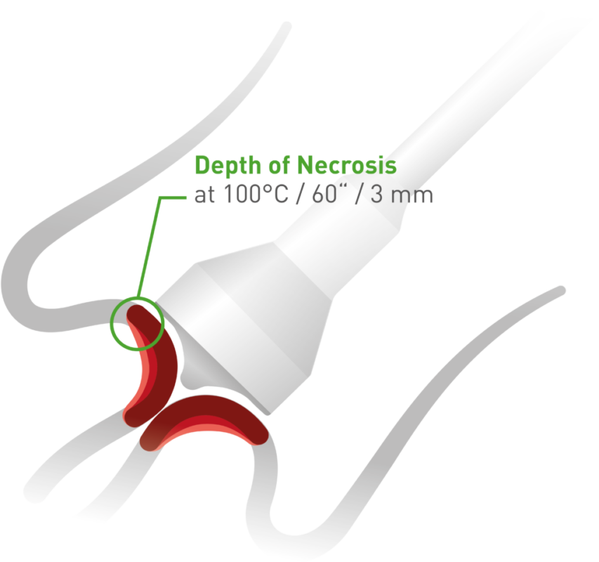 Thermal Ablation Philippines